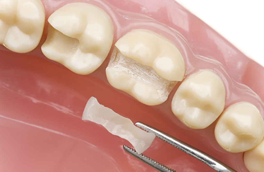 dental-inlays